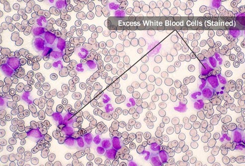 source code in blood cancer